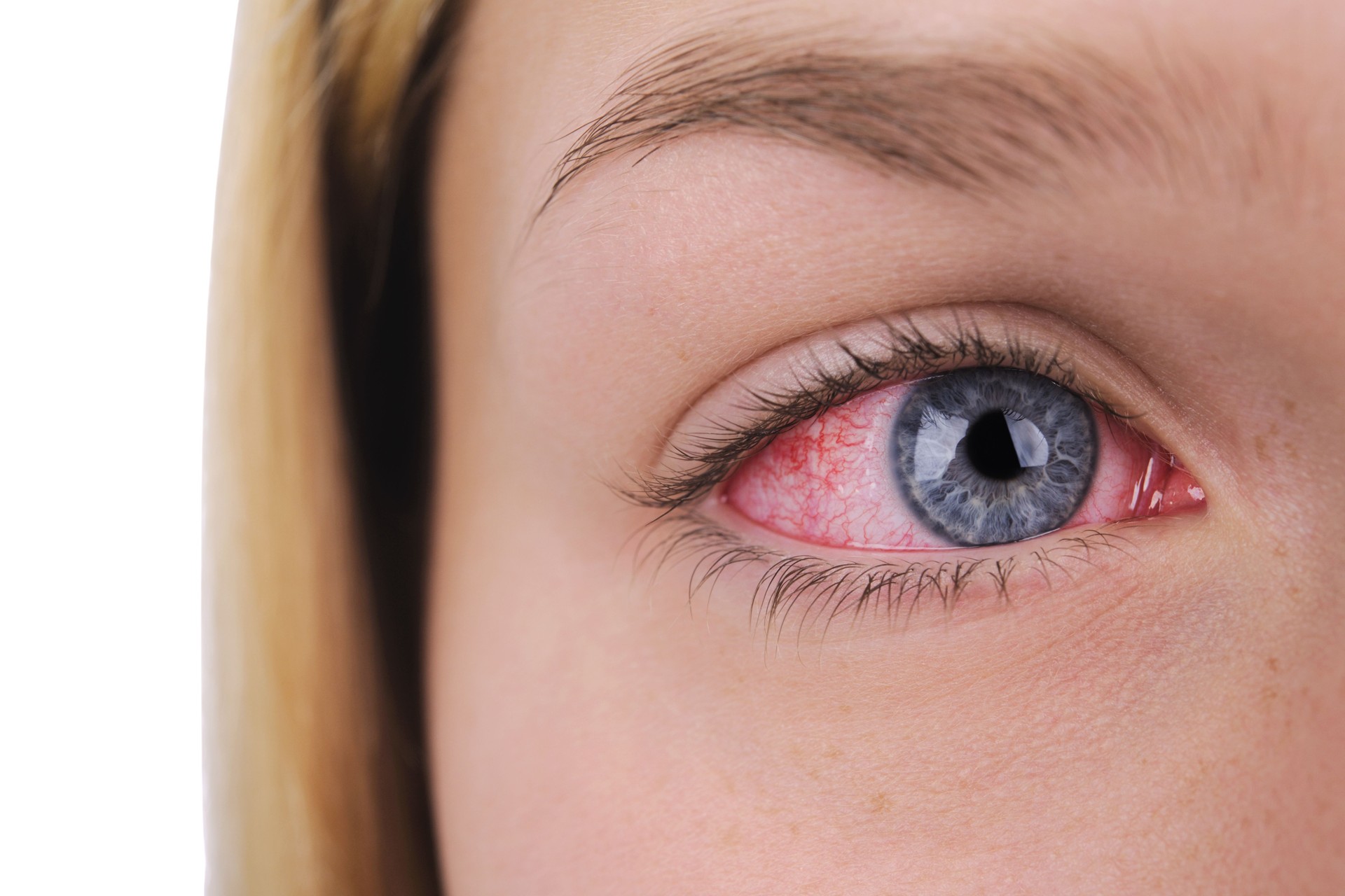 Red Sore eye